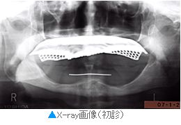 向かって左下、前から２本目の歯がインプラント