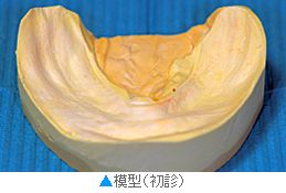 向かって左下、前から２本目の歯がインプラント