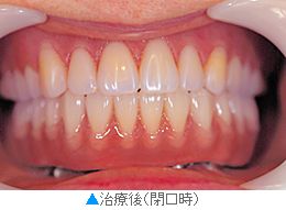 向かって左下、前から２本目の歯がインプラント