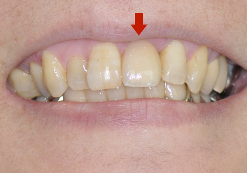 右上前歯がインプラント