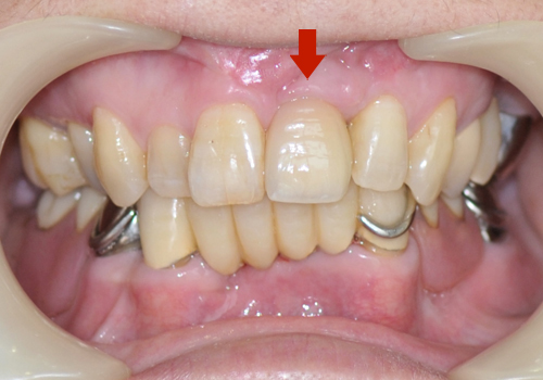 右上前歯がインプラント