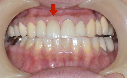 左上前歯がインプラント
