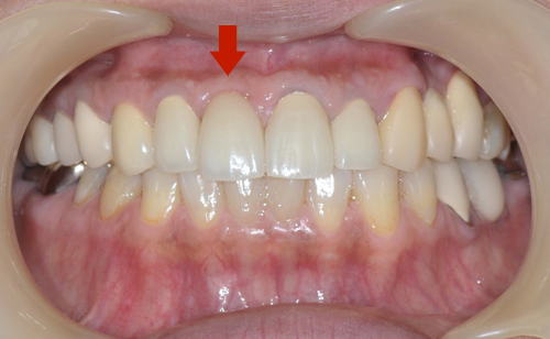 左上前歯がインプラント