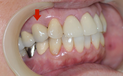 向かって左上の、前から３本目の歯がインプラント