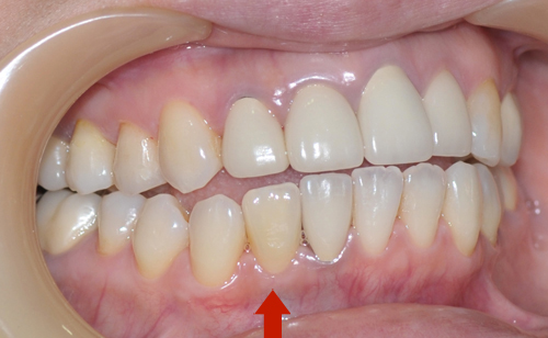 向かって左下、前から２本目の歯がインプラント